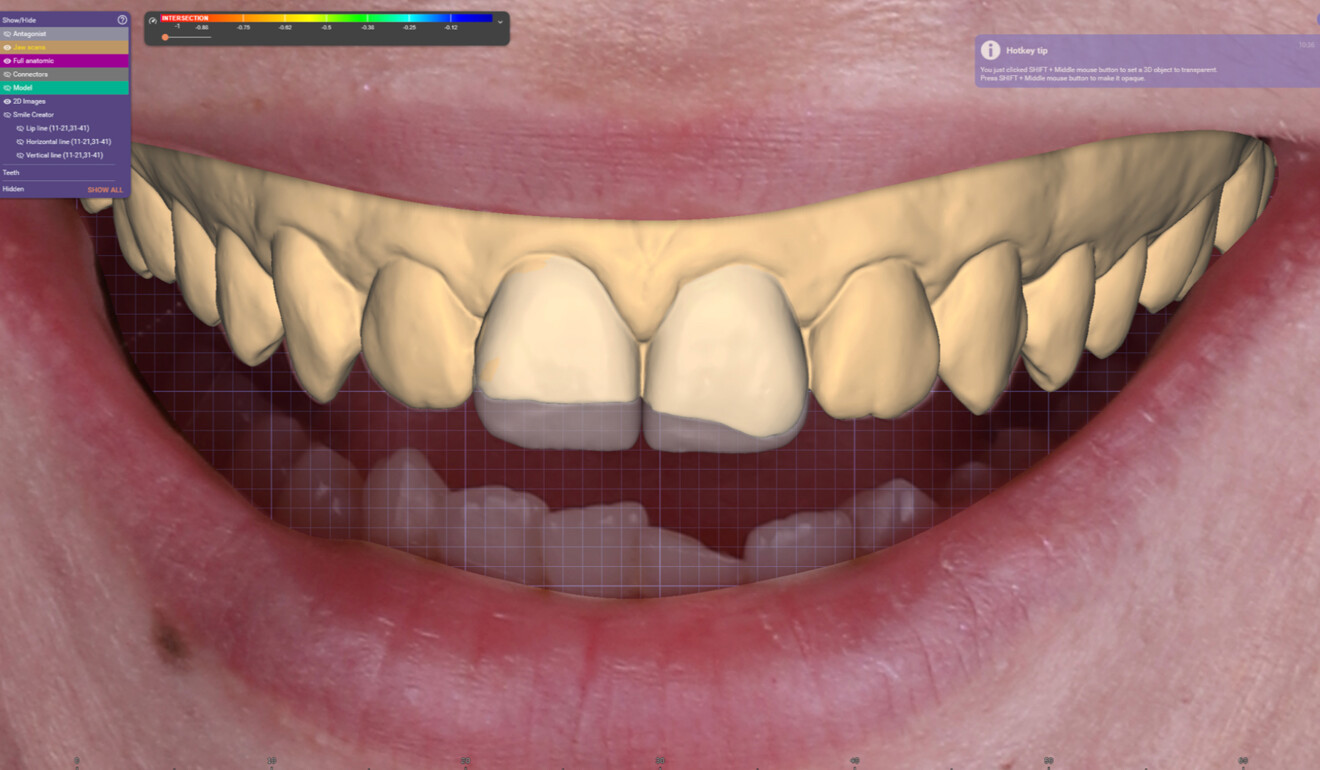 Fig. 3: Digital treatment planning (wax-up).