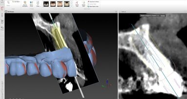Η Ψηφιακή εποχή στην εμφυτευματολογία.