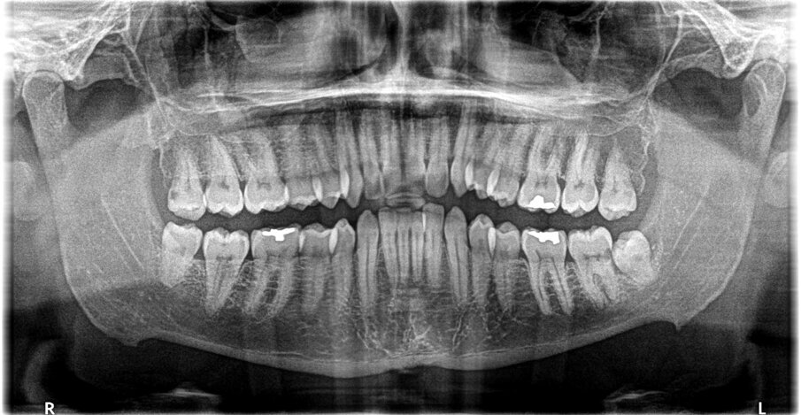 Fig. 1 - Particolare dell’ortopantomografia che evidenzia tra l’altro il danno indotto dal 3.8 semincluso sulla superficie distale del contiguo 3.7.