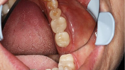 Scan perfectly with CEREC Primescan, and gain time for what is really important: your patients