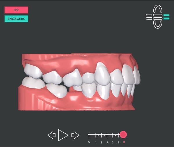 Figg. 4a, 4b - Pianificazione dei momenti. Si noti l’intrusione dell’elemento 1.6.
