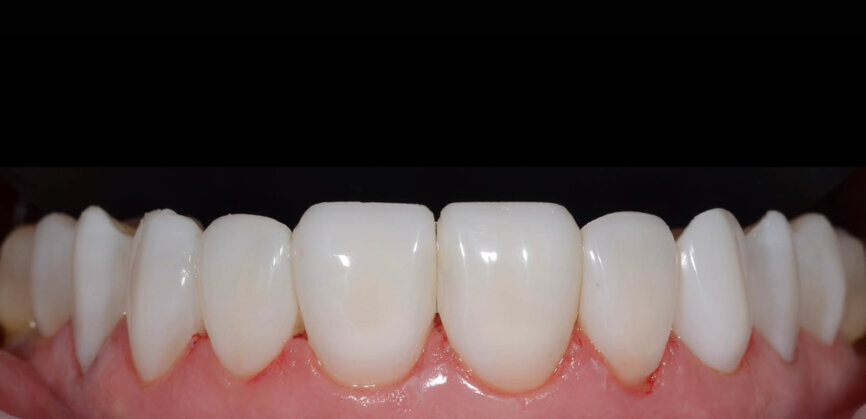 Fig. 14: This polishing protocol yielded high-shine results. 