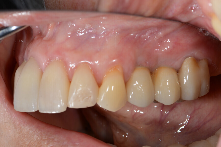 Fig. 14: Screw-retained final restorations.