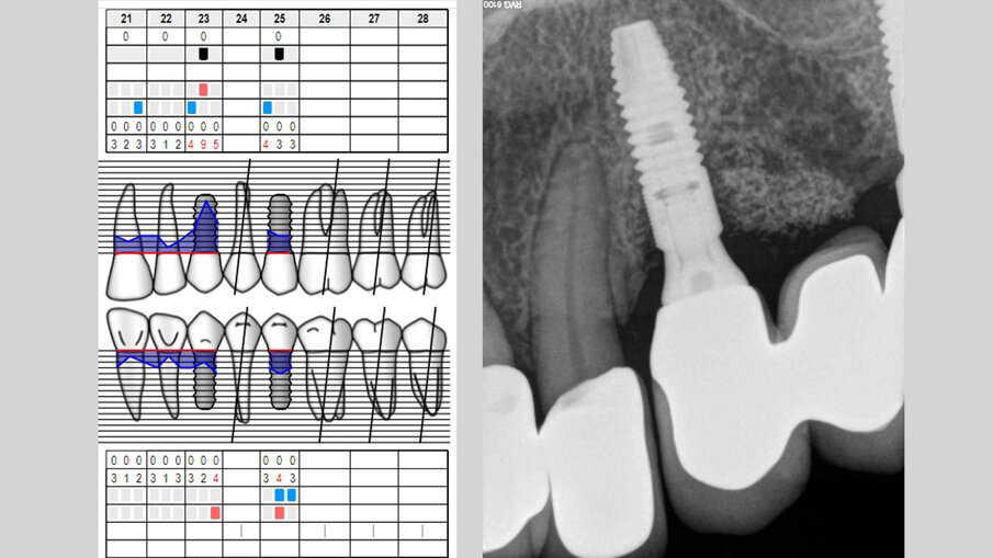 Fig. 2 - Esame RX endorale e sondaggio parodontale preperatorio.