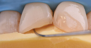 Life-Like IV klasa u dve kompozitne mase