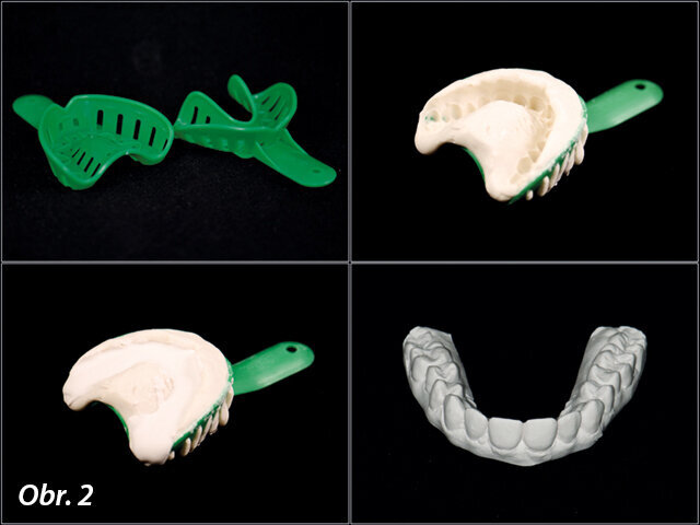 Obr. 2: Otiskování pomocí speciální otiskovací lžíce s vysokým okrajem. Použití tohoto typu otiskovací lžíce umožňuje odlití otisku bez báze. Aby bylo možno takovýto model vyjmout z otiskovací lžíce bez jakéhokoliv poškození, je nutno k jeho odlití použít vysoce kvalitní pevnou bílou dentální sádru (např. Kerr; Snow White Plaster No. 1).