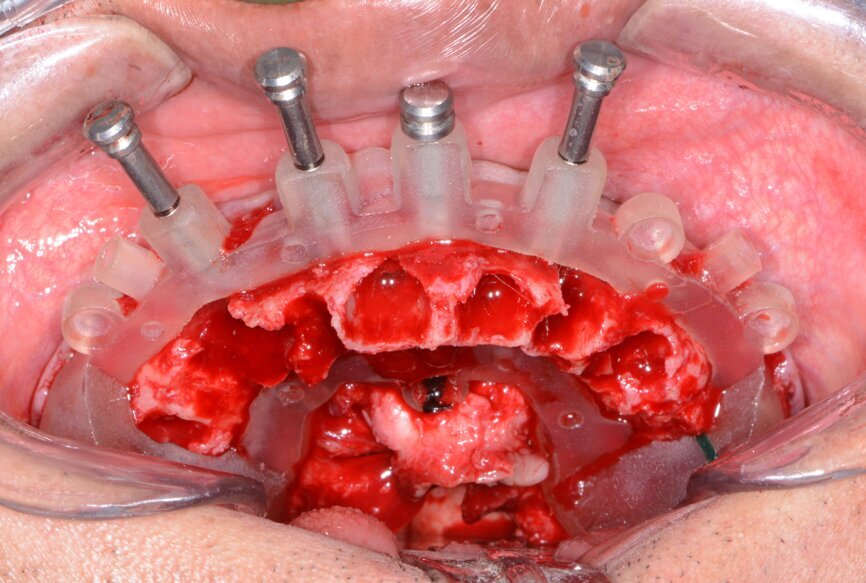 Fig. 10: Maxillary bone levelling guide.
