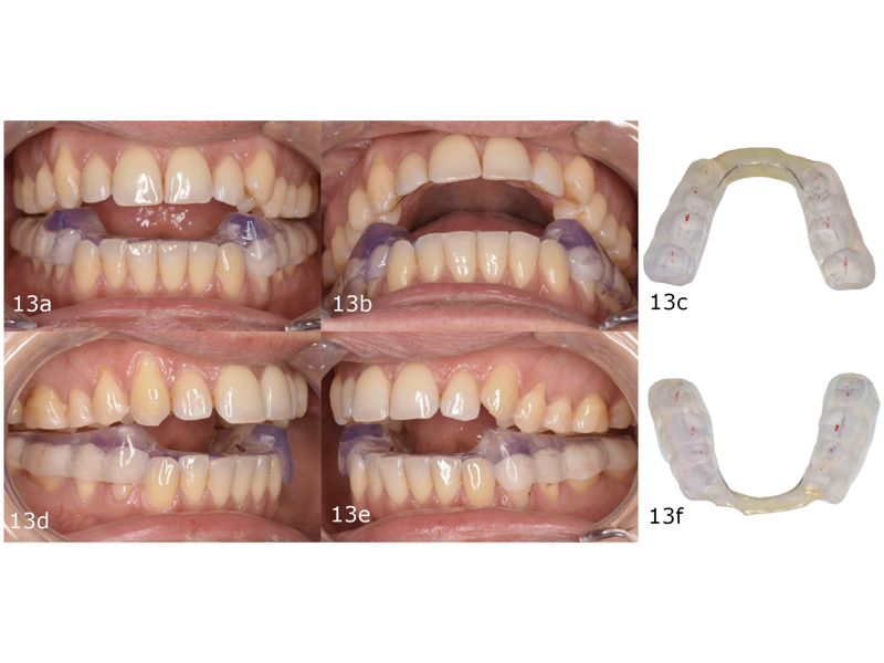 Figs. 13a–f: (a–d) Posterior splint placed in the mouth for stable occlusal contacts. (e & f) Posterior splint.