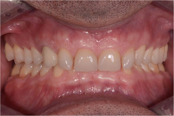 Fig.7. Dos años después, antes del tratamiento (2017).