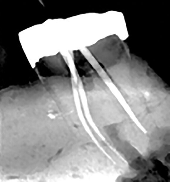 Figs. 12a–d : Depuis la gauche : Cas de l’auteur : dent
37 présentant une fracture radiculaire ; cette dent
montée dans un modèle en plâtre-pierre après extraction,
avec impression du guide de forage CTGEA
monté et du premier foret en place ; les deux
petits orifices d’accès préparés au moyen du guide
de forage ; et la radiographie postopératoire montrant
l’adaptation des cônes dans les canaux après leur négociation et leur mise en forme.
