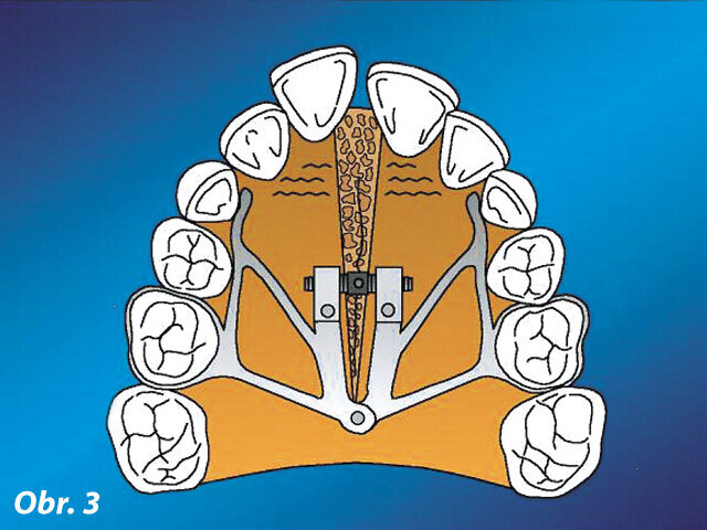 Účinky expanze v horním zubním oblouku dosaženého aktivací „pavoučího“ šroubu (Cozza et al., 2001)