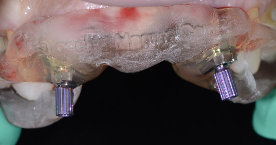 Fig. 34 - Transfert bloccati con resina trasparente.