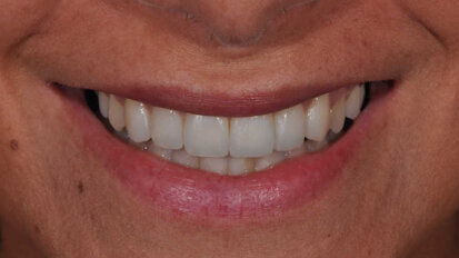 Questions de forme : modifications conservatrices des contours et contacts dentaires