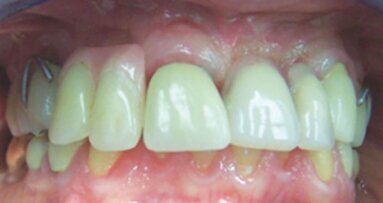 Fracture d'implant: Un regard sur les mécanismes physiques de l'échec