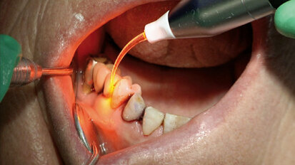 Parodontale Erhaltungstherapie völlig schmerzfrei und delegierbar