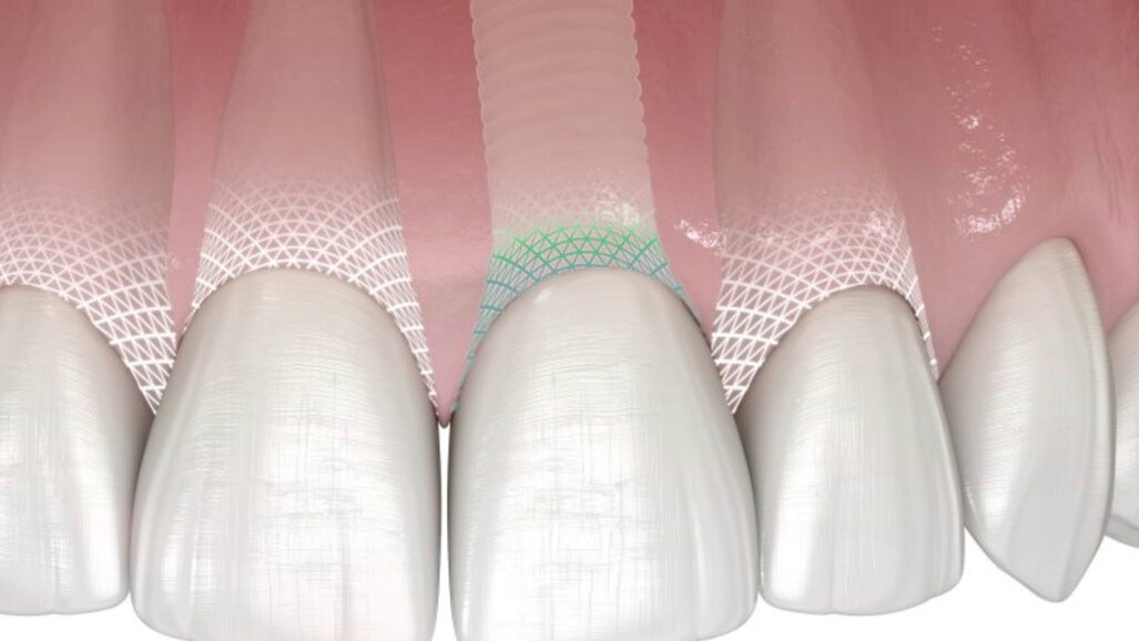Patent Medical AG apresenta Symbionic Teeth