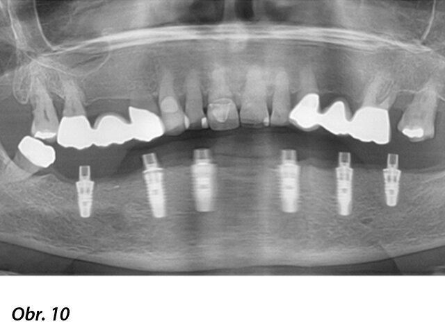 Pooperační panoramatický RTG snímek.