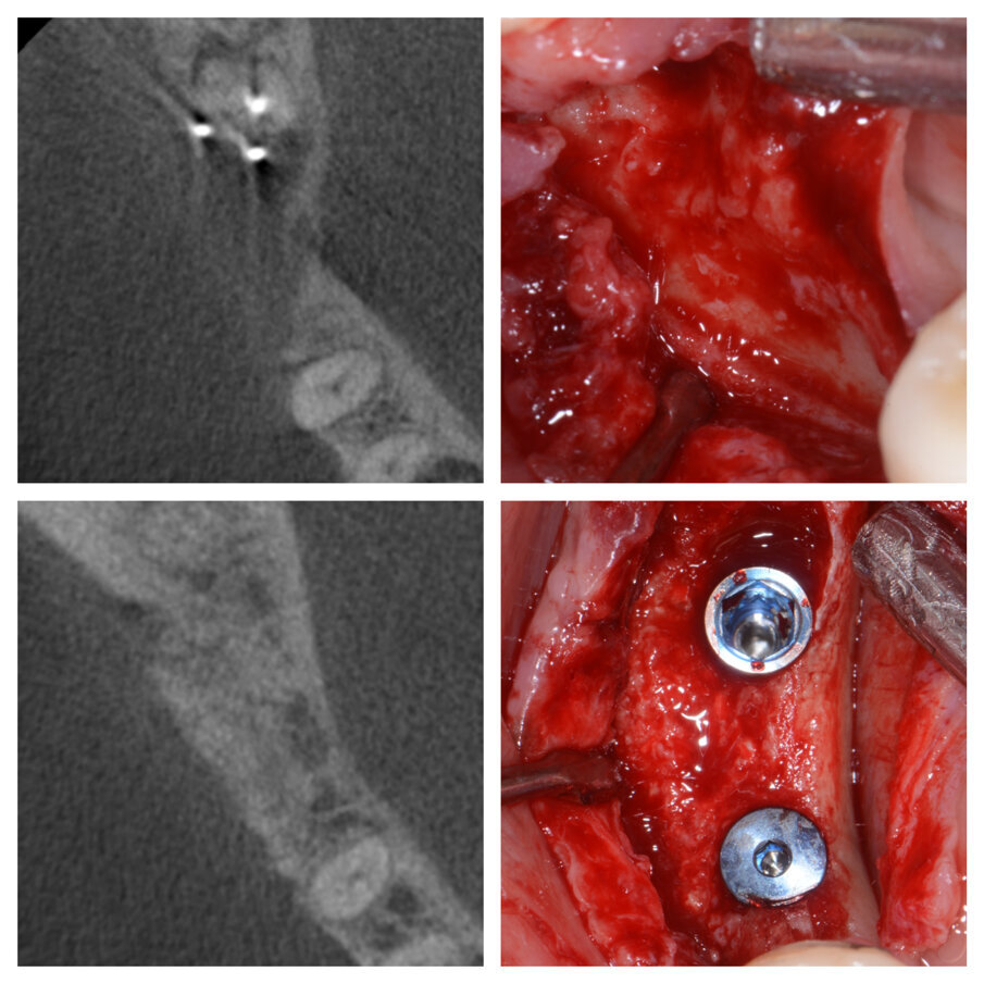 Fig. 1d_Tessuti duri prima e dopo la tecnica S.A.T., posizionamento implantare.