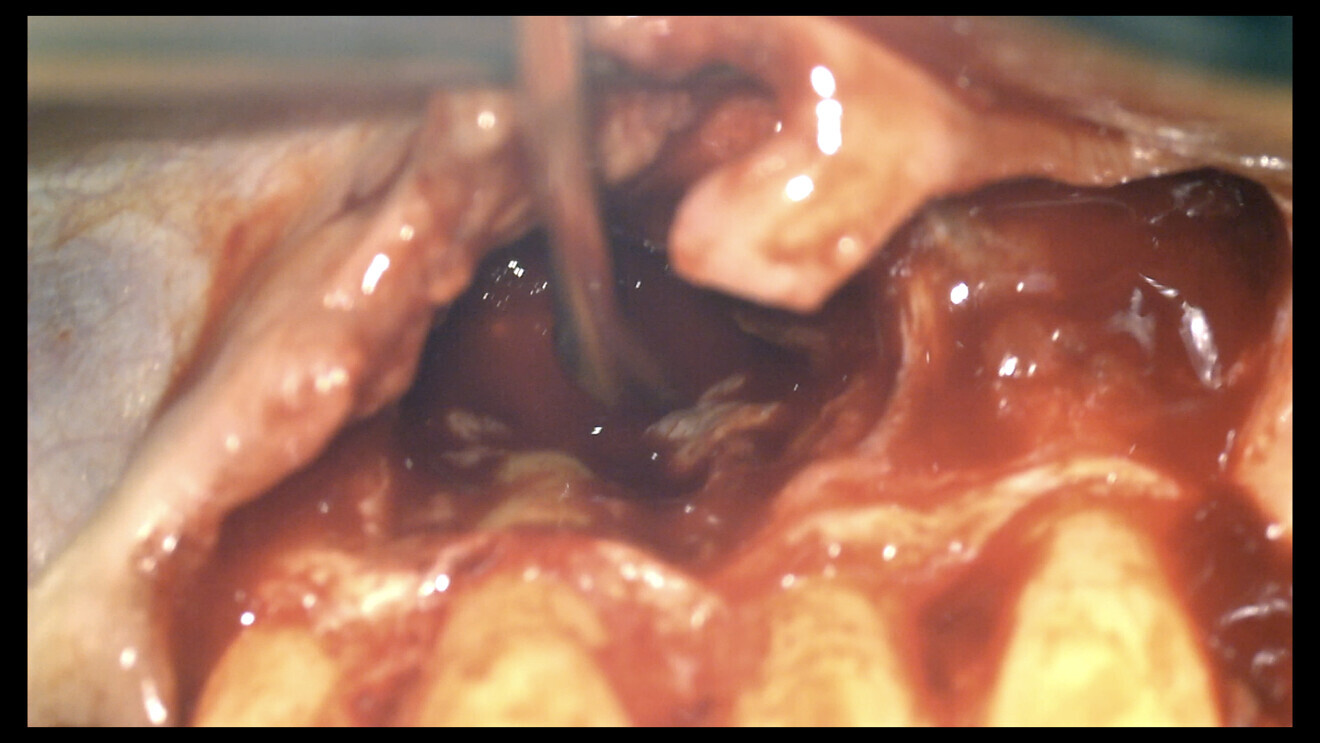 Fig. 3: Zero apicectomy technique performed on both central incisors.