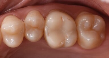 A biomimetic approach to restoration after endodontic treatment