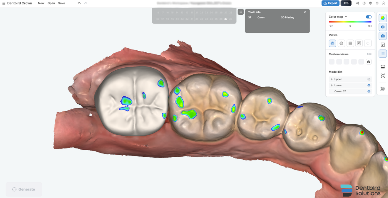 Fig. 6c: Occlusal view showing the distribution and intensity of contacts with adjacent dentition.