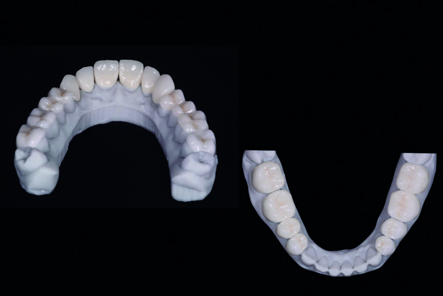 Fig. 10 : Les facettes et couronnes définitives préparées par un flux de travail numérique au moyen du logiciel de conception Ceramill Mind et fabriquées dans une unité d’usinage (Ceramill Motion 2) à partir de blocs de céramique au disilicate de lithium (VITABLOCS TriLuxe forte). 