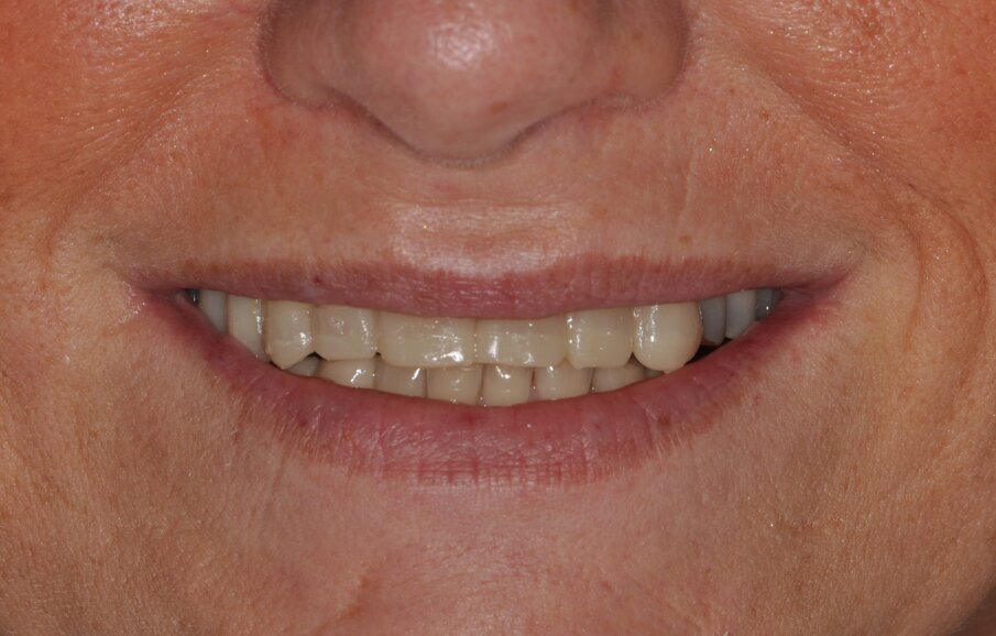 Fig. 3: Baseline situation for designing the esthetic anterior restorations following bite raising in the posterior region