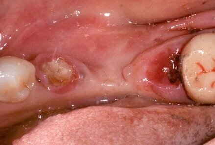 Fig. 7 - Rimozione manufatto protesico.