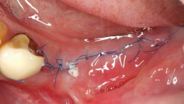 Nici chirurgiczne – typy i zastosowanie w chirurgii jamy ustnej