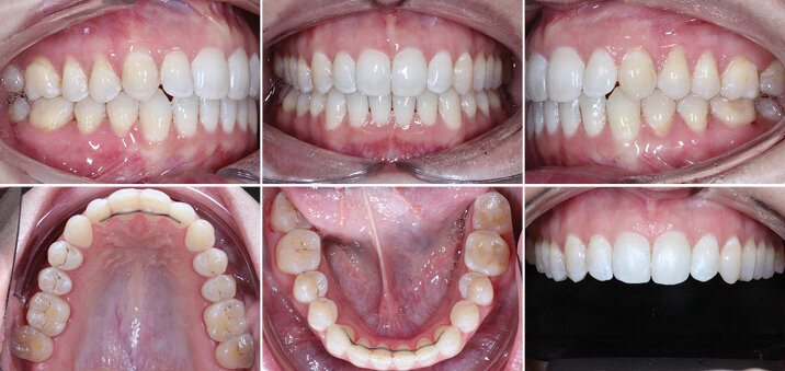 Sejmutí – 62 týdnů