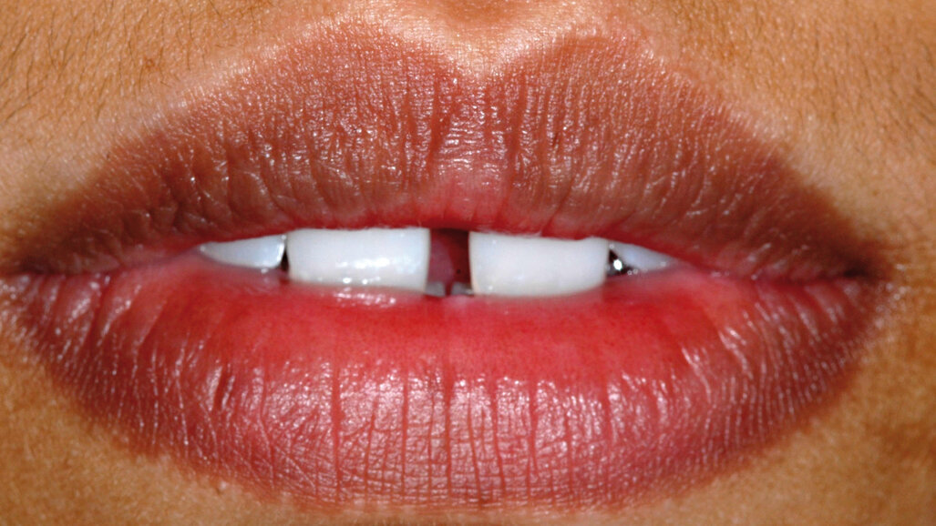 Diastema mediana- zatvaranje korištenjem direktnih adhezivnih restauracija