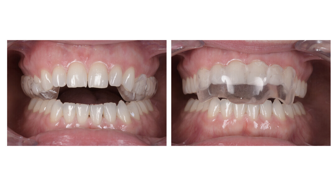 Figs. 41a & b: Two-piece FACE splint. Posterior segment (a). Anterior segment (b).