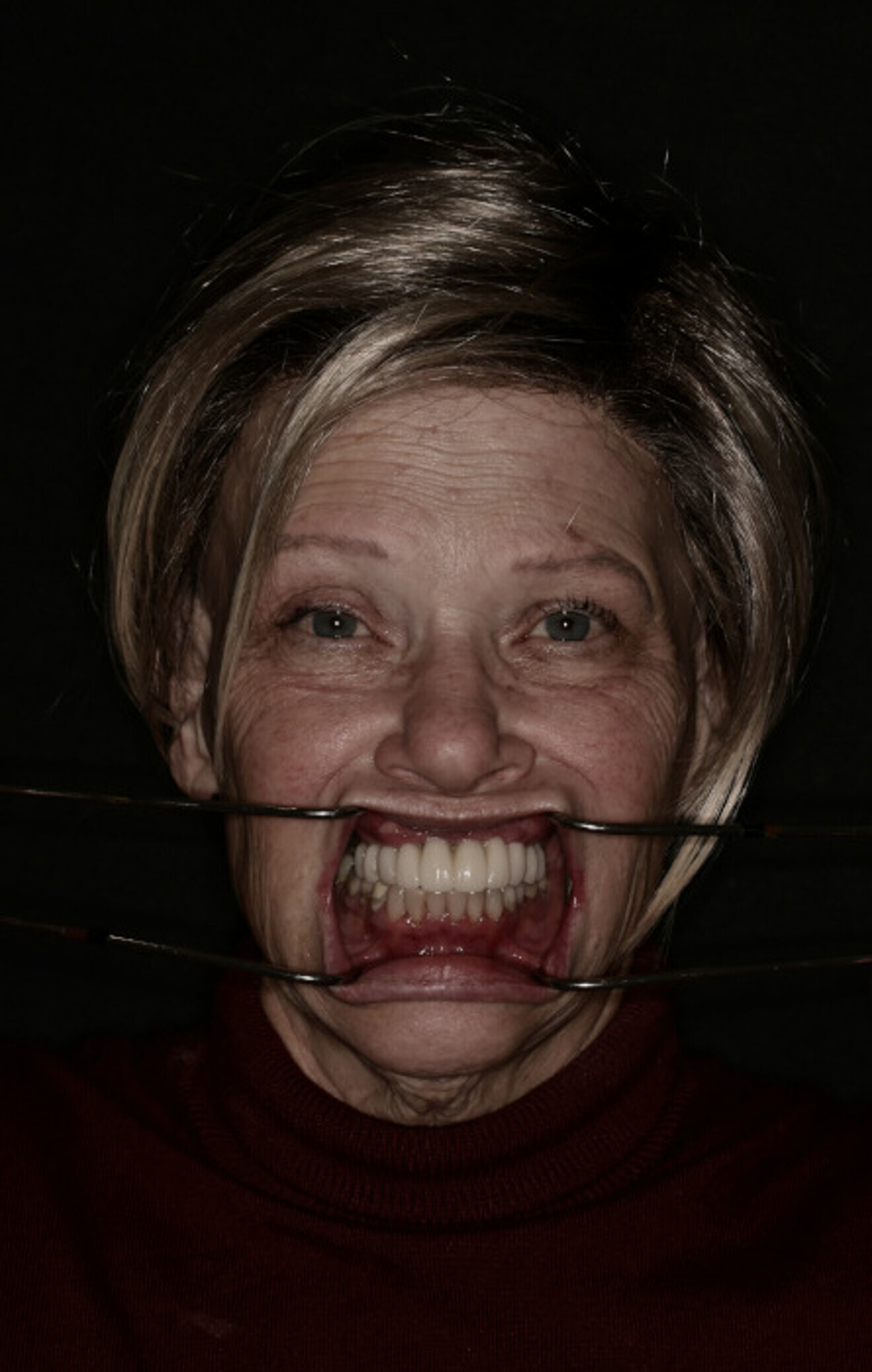 Fig. 20a: Provisional prosthesis before design modification.