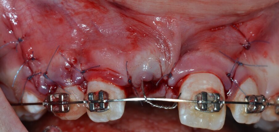 Fig. 19_Riposizionamento del filo ortodontico.