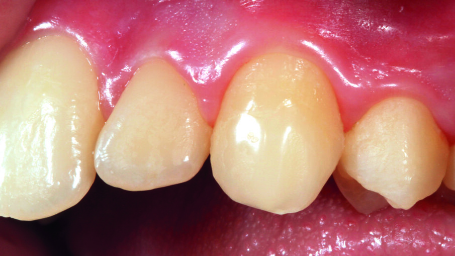 Afbeelding 11. Opname tijdens een controle na één jaar. Er zijn minder plaque-gebieden op de composietrestauratie dan op de aangrenzende tandstructuren. 