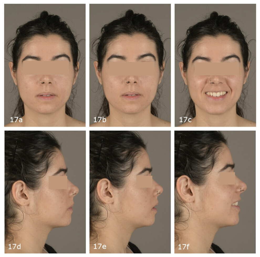Figs. 17a–f: Pretreatment extra-oral photographs.