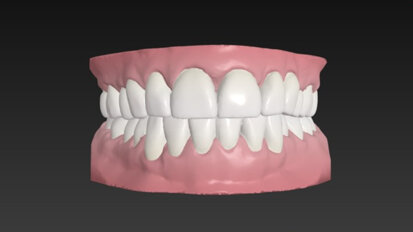 Digital workflows for complex adult aligner treatment