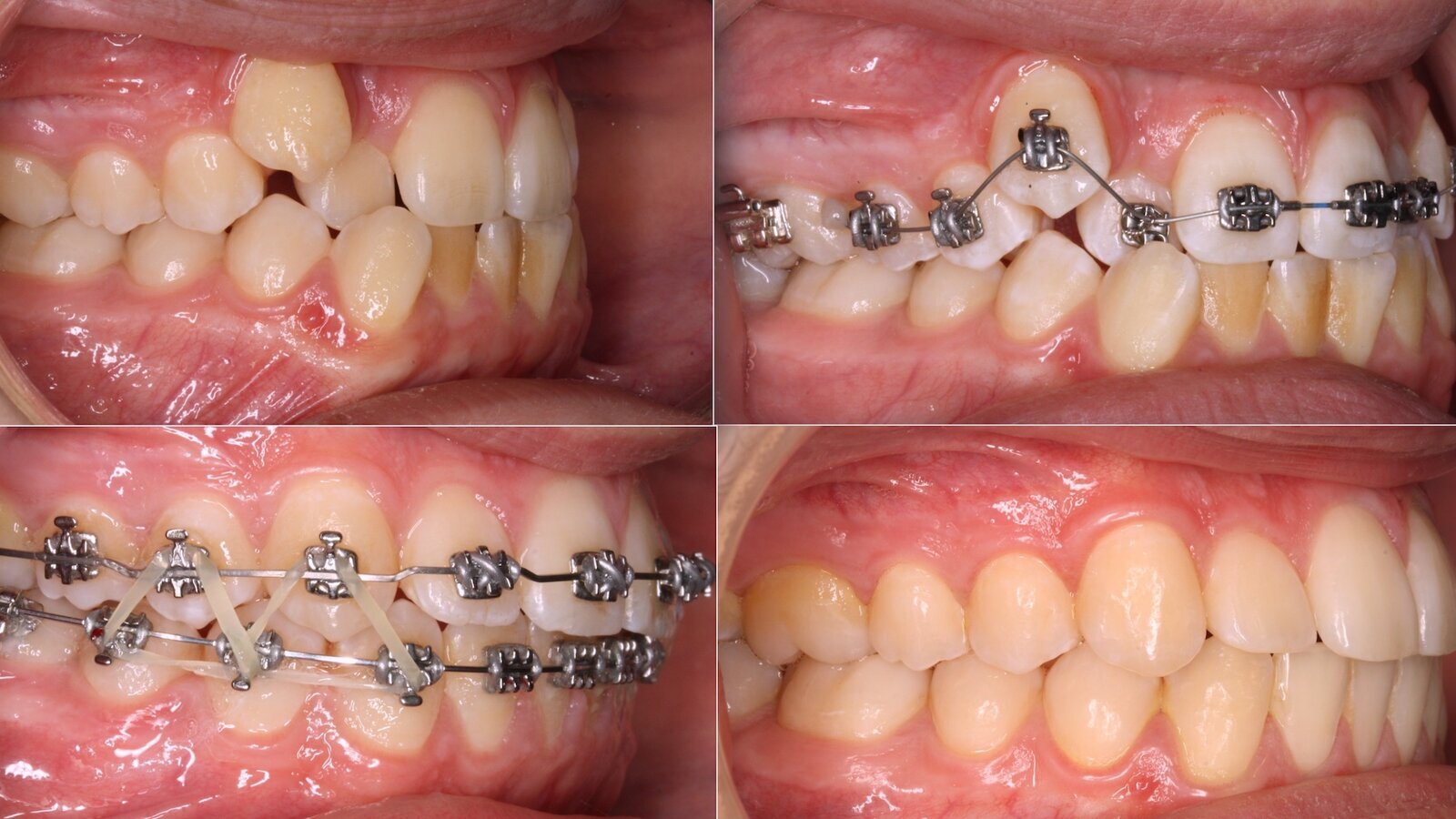 ¿Extracción o Expansión en Ortodoncia? (4)