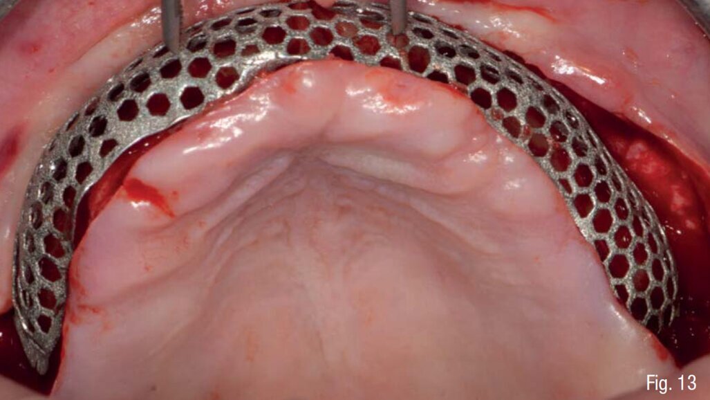 Riabilitazione di un mascellare gravemente atrofico mediante approccio digitale