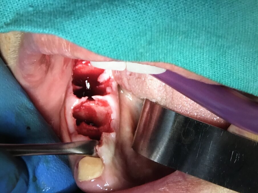 Fig. 11 - Fase 1: siti estrattivi preparati in modo traumatico con Courretage.