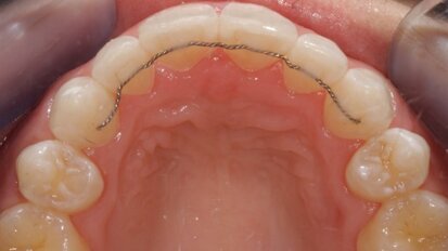 The Inman Aligner: Alignment, bleaching and bonding—A progressive approach to smile design (Part II)