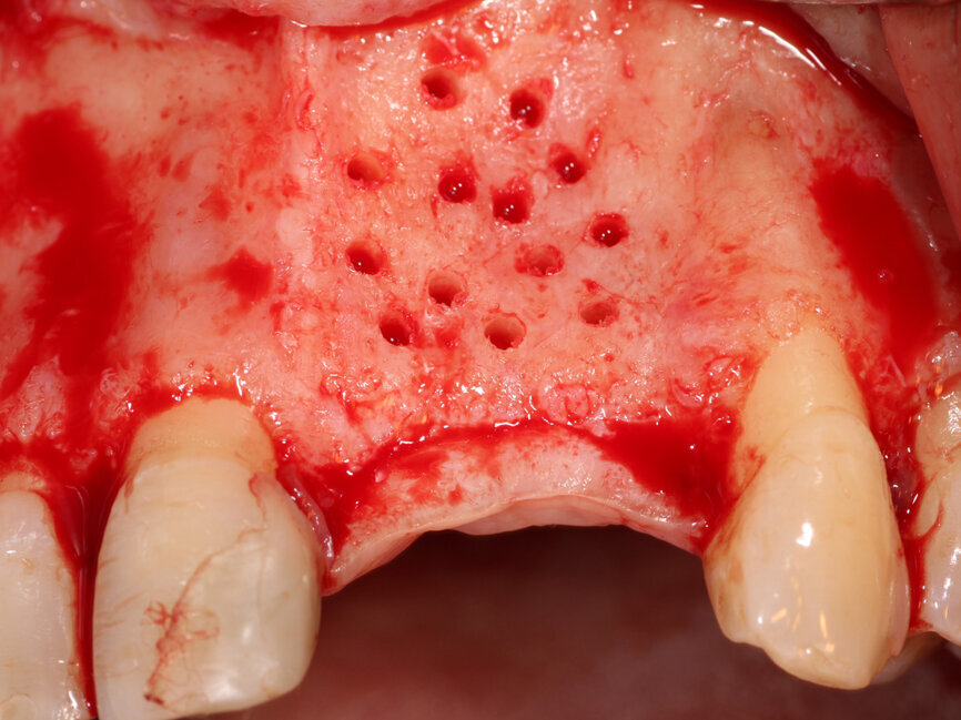 Fig. 4: The facial plate is fenestrated with a bur through the cortical bone in the edentulous space that will receive the osseous graft.
