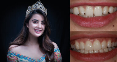 Celebrities’ Smile Makeup—the MiCD way