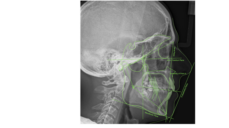 Fig. 59_Radiografia laterale post-trattamento con tracciato cefalometrico.