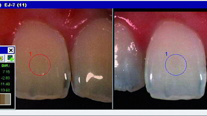 Blanchiment dentaire : une approche conservatrice