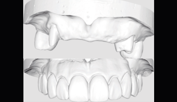 Fig 9. Prepared cast and Diagnostic cast were scanned and transformed into STL file.