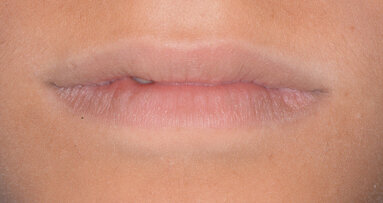 La terapia di mantenimento e l’approccio clinico D-BIOTECH: case report