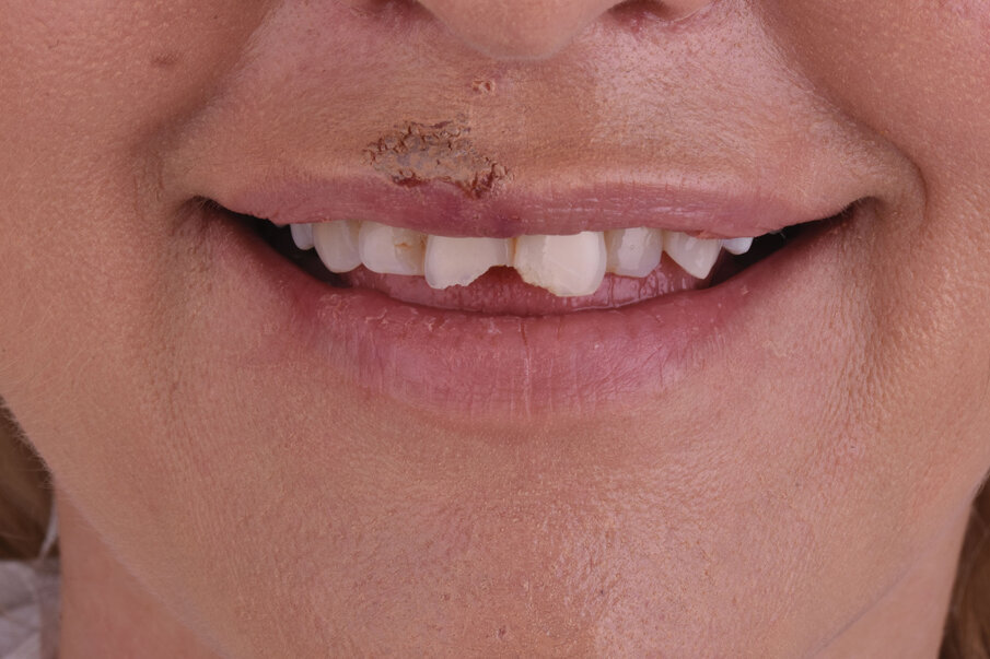 Sl. 1: Inicijalna situacija. Fraktura gornjih centralnih inciziva sa  povredom mekog tkiva usne i brade