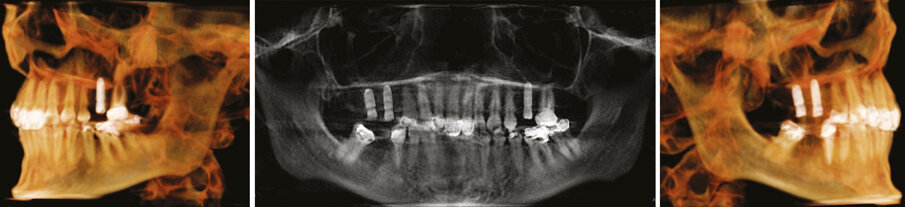 Figs.22-24: Final CT reconstructions and Pan xray.