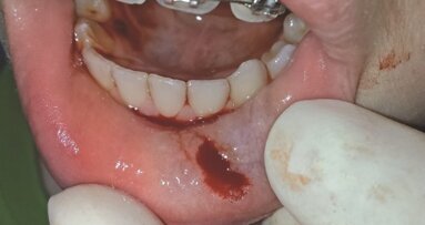 Leczenie mucoceli laserem Er:YAG – opis przypadku